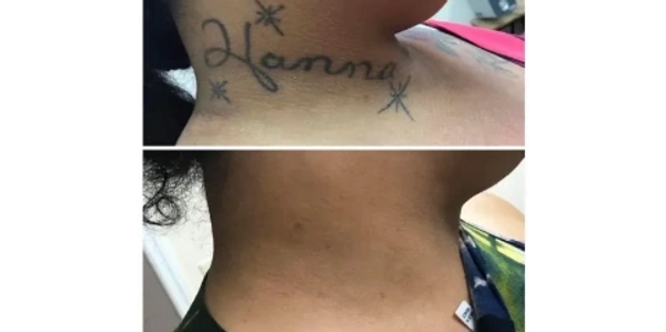 Neck Tattoo Removed