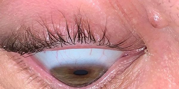 Keratoconus eye