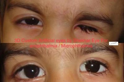 Anophthalmia / Microphthalmia management with custom artificial eyes by experienced Ocularist.