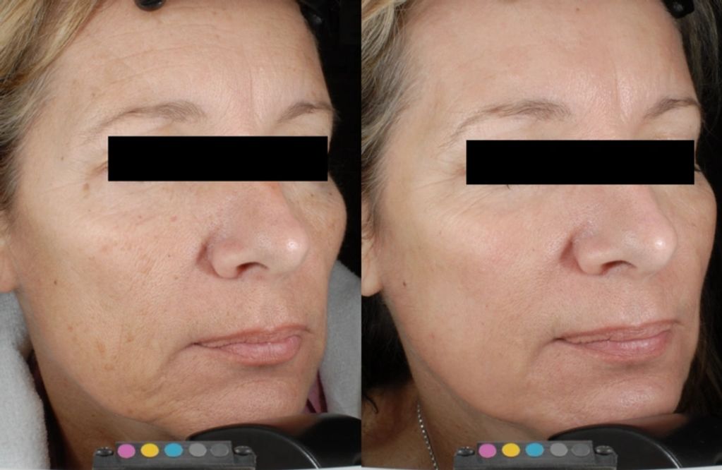 My CO2 Laser + Filler + Microneedling Update & Thoughts… : r/AcneScars