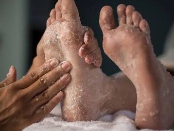 Close-up of dry, cracked feet being cared for.
