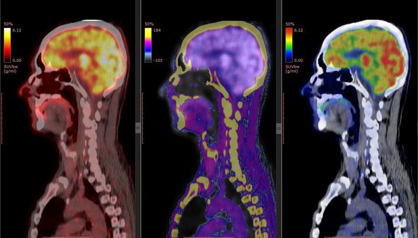 Three side-view brain scans showing different imaging modes.