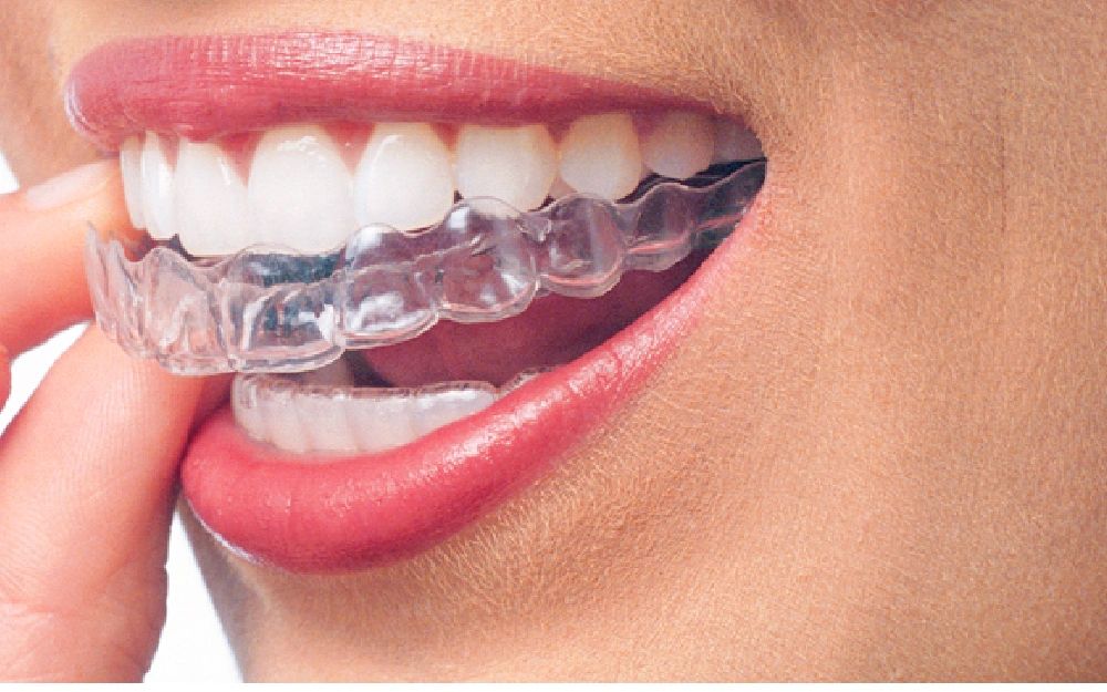 retainer designs like brace