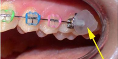 Poking Wire? Here are Some Pointers - Orthodontist Newark Middletown DE  Invisalign Braces Honig Orthodontics, Wire For Braces 