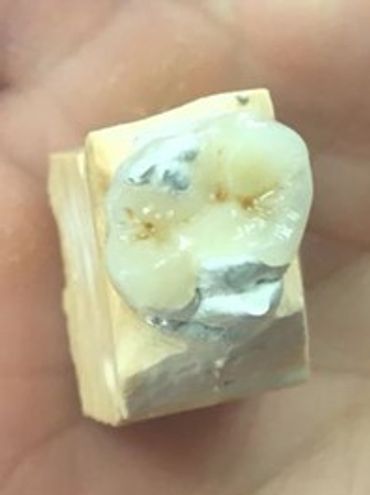 Close-up of a dental model with a tooth restoration.