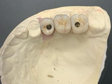 Dental model with implants and crowns.