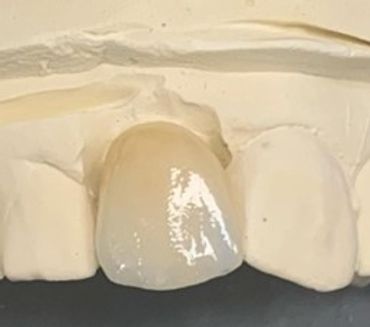 Close-up of a dental crown on a model.
