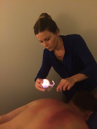 Dr. Teresa Wlasiuk doing fire cupping on a patient prone.