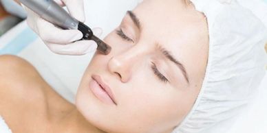 micro needling Haarlem, Amsterdam, Overveen, Bloemendaal, Heemstede, schoonheidssalon Haarlem