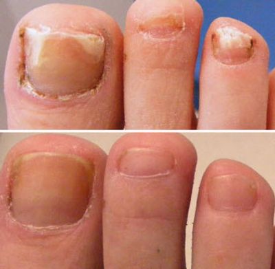 Toenail fungus before and after the Cutera Laser Treatment
