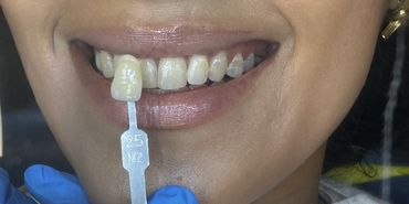 teeth whitening