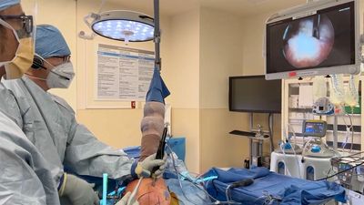 Orthopedic Surgeon using Tensor Surgical's TransOs Tunneler to perform anchorless rotator cuff repai