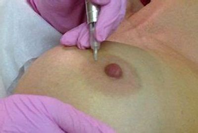 Areola tattoo after mastectomy 