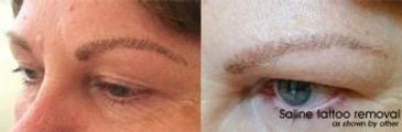 Microblading saline removal near me