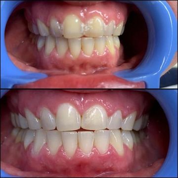 All natural teeth whitening before and after