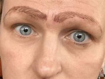 Removing bad Microblading 