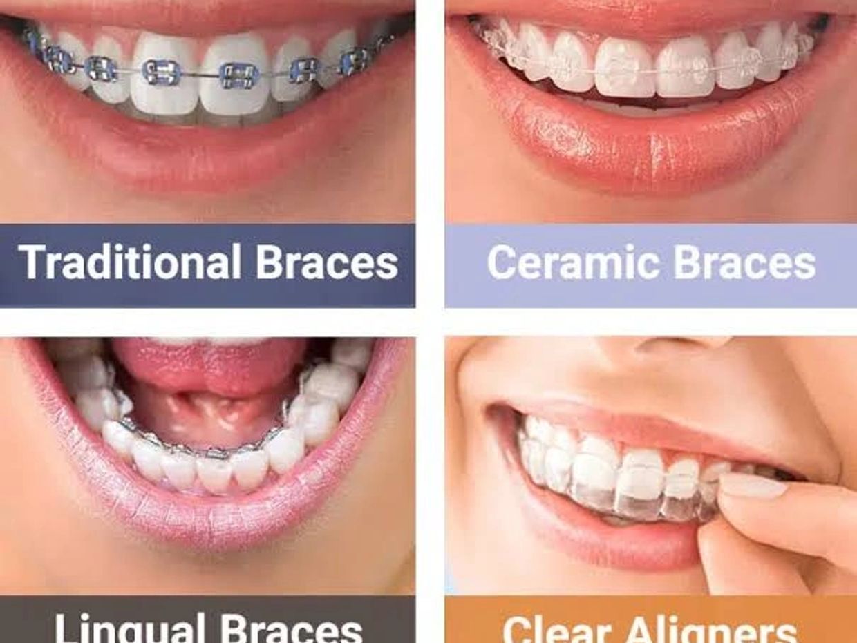 Braces at face1 dental noida