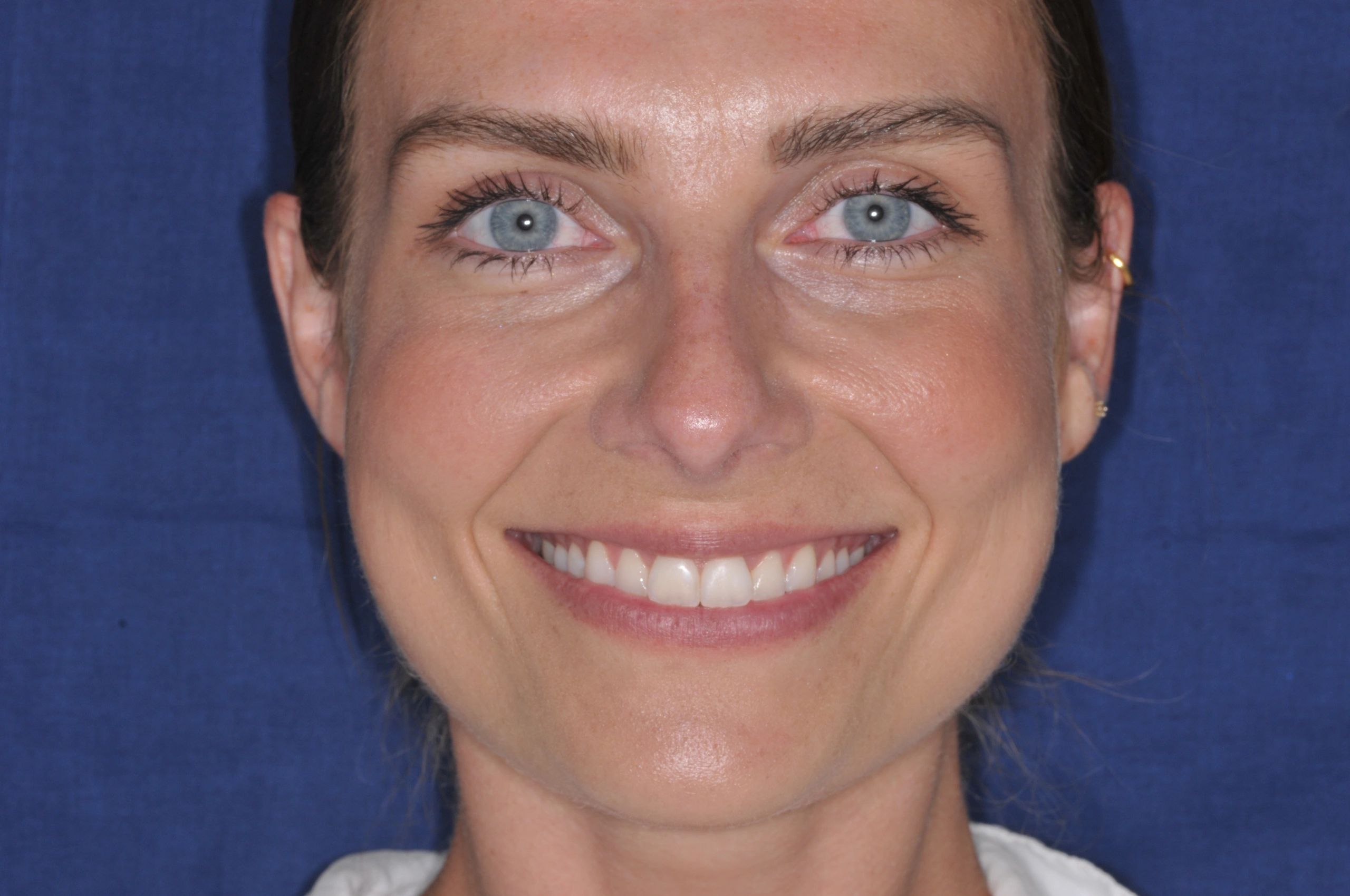 Gallery Manchester Clear Braces