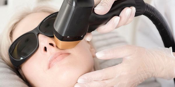 Facial laser hair removal