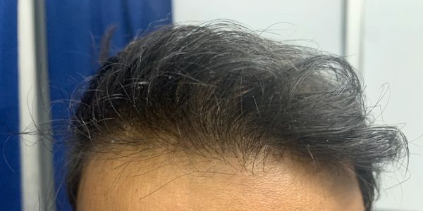 Hair Line Design for Frontal Hair Loss Androgenetic Alopecia | FUE Hair Transplant