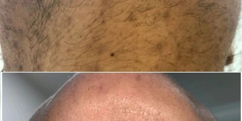 Permanent Hair Reduction | Laser Hair Reduction | Unwanted Hair Removal | Dr Kuldeep Bhardwaj