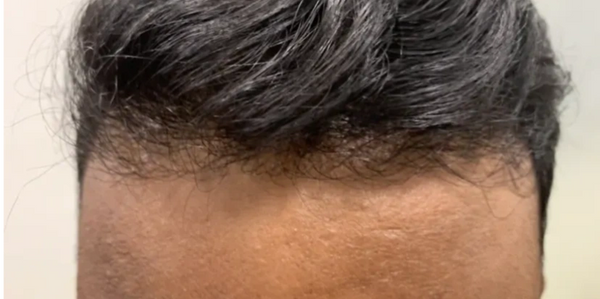 Hair Transplantation for Frontal Hair Loss | FUE Hair Transplant