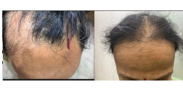 Female Hair Transplantation for Frontal Hair Loss | FUE Hair Transplant for Females