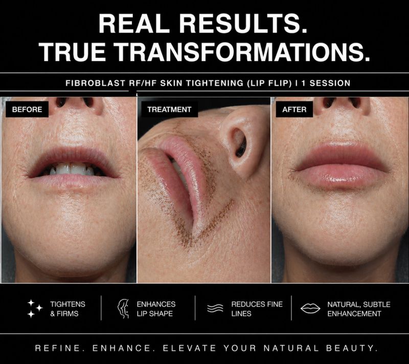 Fibroblast RF/HF "Lip Flip" Skin Tightening