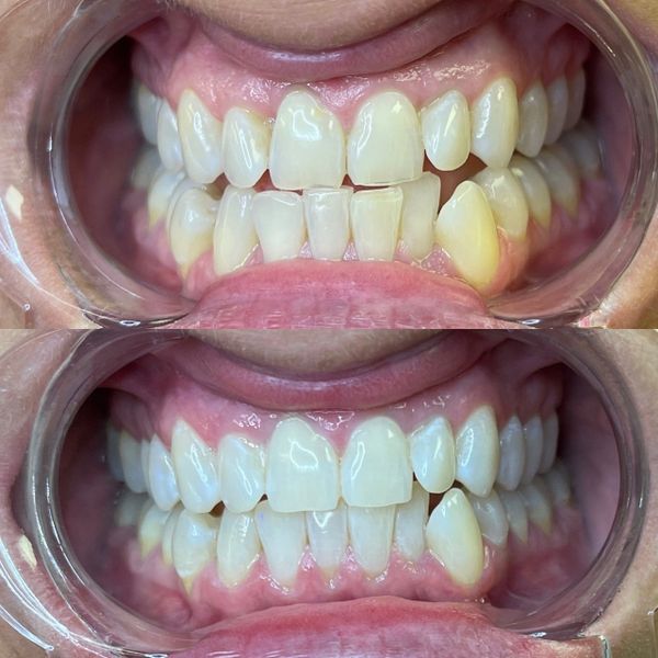 Tooth Gems  Newave Whitening