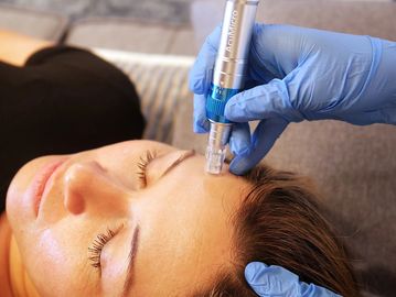 nanoneedling pen being used on woman's forehead