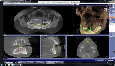 Implant planing and surgical guids