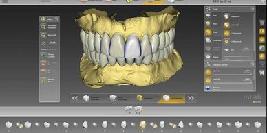 Digital wax Up made by Ecoxad smile design. we are Dentsply sirona cerec certified dental Laboratory