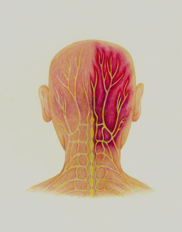 Illustration of scalp nerves with inflammation on one side.
