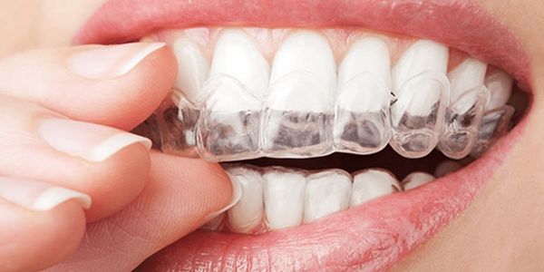 Person placing a clear dental aligner on teeth.