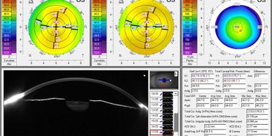 Corneal topography is a powerful tool   to assess corneal shape . Accurate measurements are critical