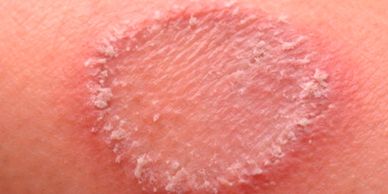 Close-up of a round, scaly skin patch.