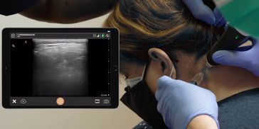 Ultrasound-guided Great Occipital nerve block.