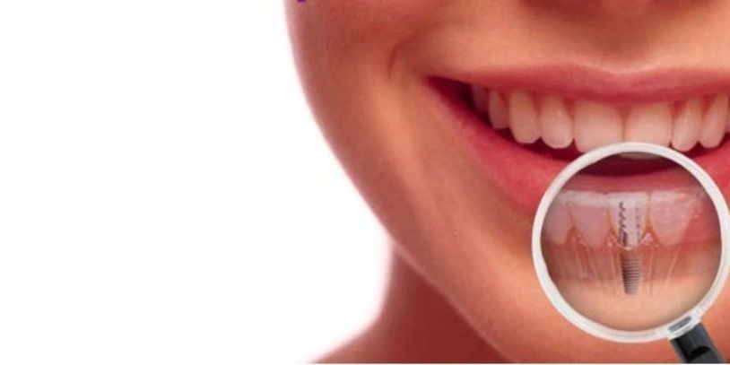 Nobel Biocare
Straumann
Loose dentures
loose implants
implant pain
implant battersea
implant London 