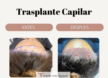 Before and after images of a hair transplant procedure.