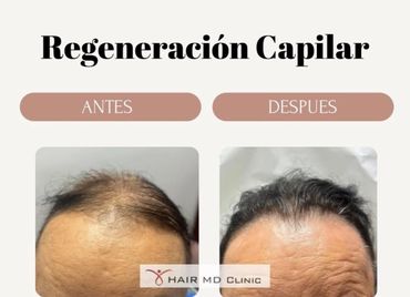 Before and after hair regeneration treatment showing improved hair density.