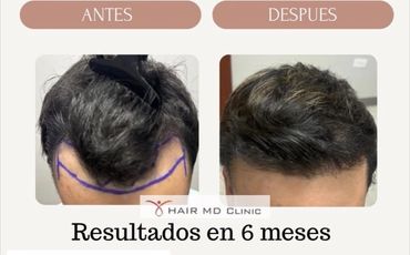 Comparación de antes y después de un tratamiento capilar en 6 meses.