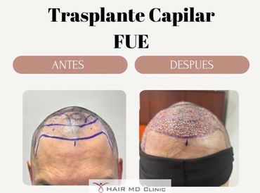 Before and after photos of a FUE hair transplant procedure showing scalp markings and graft implantation.