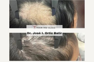 Before and after hair restoration showing significant hair regrowth.
