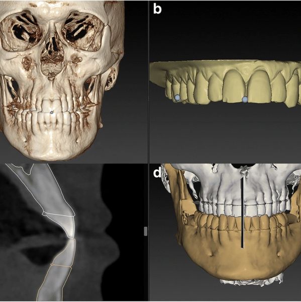 LargeV Smart3D-X Dental Tomografi