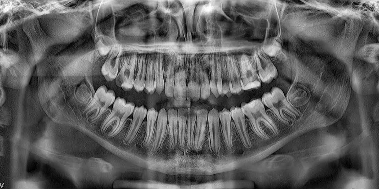 LargeV Smart3D-X Dental Tomografi