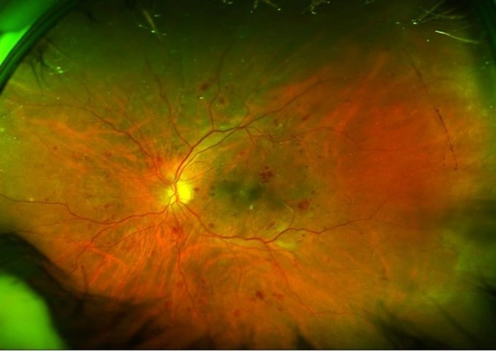 Tratamiento de la retinopatía diabética