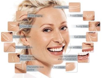 Diagram highlighting common facial wrinkles and areas for cosmetic treatments on a smiling woman.