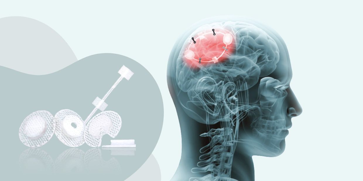 X-ray of a human head with a highlighted brain implant area and device parts.