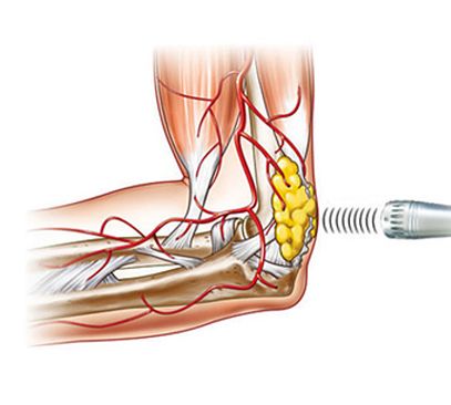 Laser Shockwave Therapies