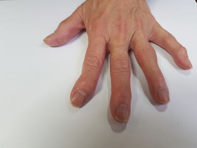 Osteoarthritis Acupuncture Best Professor Yoland Lim Australia Melbourne Dr Justin Lim treatment